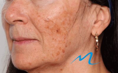 Les taches brunes (pigmentaires)